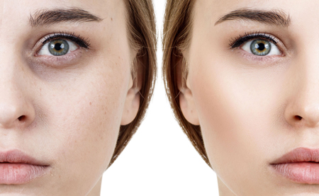 بهترین برندهای فیلر زیر چشم